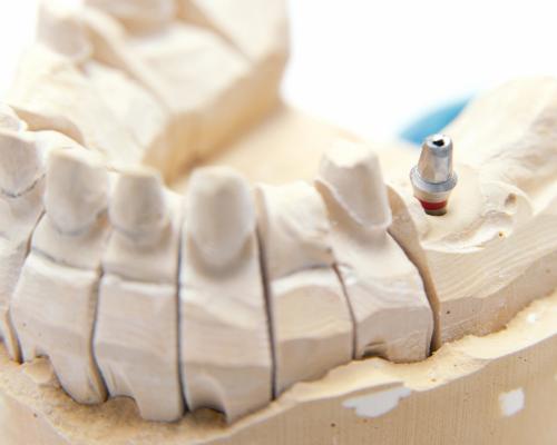 Tooth model showing dental implant